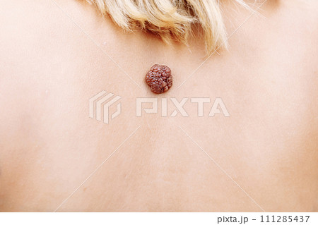 Wart. Mole. big wart on the skin. Skin diseases Malignant tumor. Dermatology. Oncology. selective focus. Wart. Mole. big wart on the skin. Skin diseases Malignant tumor. Dermatology. Oncology. selective focus. 111285437