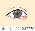下まぶたにできたものもらい 111297770