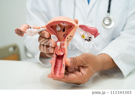Uterus, doctor with anatomy model for study diagnosis and treatment in hospital. 111343303