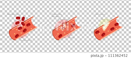 3D Isometric Flat Conceptual Illustration of Hemostasis, Wound Healing Process Stages, Vasoconstriction and Clot Formation 3D Isometric Flat Conceptual Illustration of Hemostasis, Wound Healing Process Stages, Vasoconstriction and Clot Formation 111362452