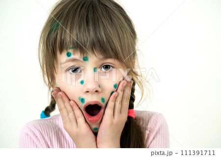 Child girl covered with green rashes on face ill with chickenpox, measles or rubella virus. 111391711