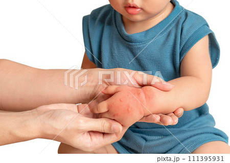 Asian baby have red swollen and blister on hand caused by insect bite, on white background. Asian baby have red swollen and blister on hand caused by insect bite, on white background. 111395931