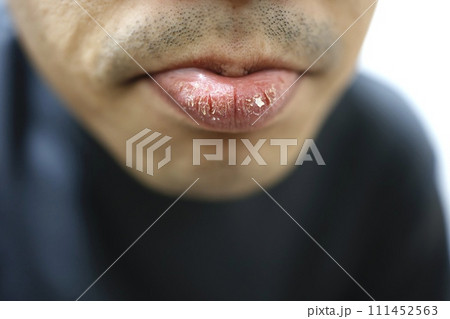 男性の唇が乾燥している 男性の唇が乾燥している 111452563