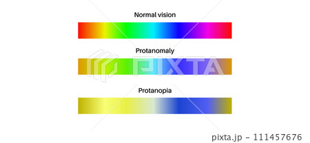 Protanomaly and protanopia 111457676