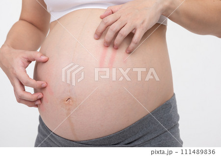 Close up Pregnant woman scratching her big belly itchy skin.Unrecognizable pregnancy woman having a skin problem on belly and scratching on itchy spot.Pregnancy Care Concept 111489836
