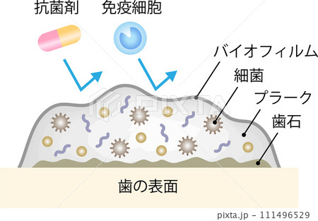 バイオフィルム 歯 バイオフィルム 歯 111496529