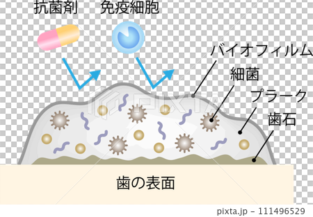 バイオフィルム 歯 バイオフィルム 歯 111496529