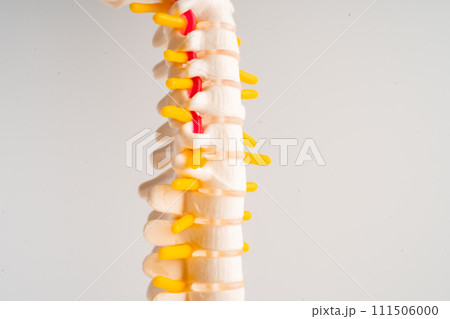 Lumbar spine displaced herniated disc fragment, spinal nerve and bone. Model for treatment medical in the orthopedic department. Lumbar spine displaced herniated disc fragment, spinal nerve and bone. Model for treatment medical in the orthopedic department. 111506000