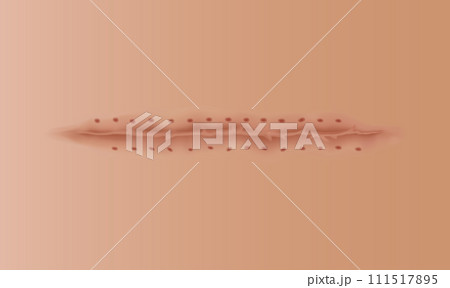 Healing wounds, skin scar, stitched gash and cut. Realistic surgical suture, stitched wounds. Healing stage on human skin background. Vector illustration Healing wounds, skin scar, stitched gash and cut. Realistic surgical suture, stitched wounds. Healing stage on human skin background. Vector illustration 111517895