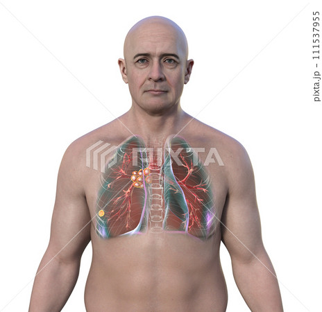 Primary lung tuberculosis with the Ranke complex, 3D illustration 111537955