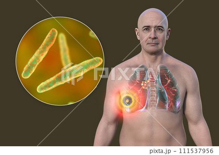 Primary lung tuberculosis with the Ranke complex, 3D illustration 111537956