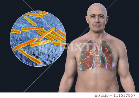 Primary lung tuberculosis with the Ranke complex, 3D illustration 111537957
