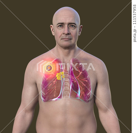 Primary lung tuberculosis, 3D illustration 111537958