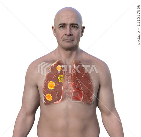 Pulmonary blastomycosis, 3D illustration. 111537966