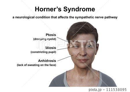 A woman with Horner syndrome, 3D illustration 111538095