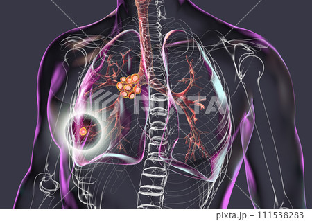 Primary lung tuberculosis with the Ranke complex, 3D illustration 111538283