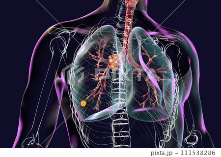 Primary lung tuberculosis with the Ranke complex, 3D illustration Primary lung tuberculosis with the Ranke complex, 3D illustration 111538286