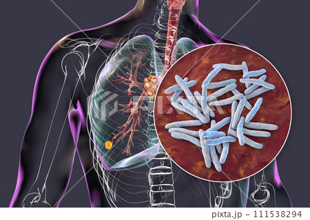Primary lung tuberculosis with the Ranke complex, 3D illustration 111538294