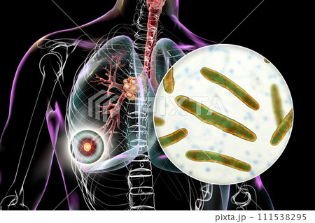 Primary lung tuberculosis with the Ranke complex, 3D illustration 111538295