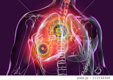 Primary lung tuberculosis, 3D illustration 111538300