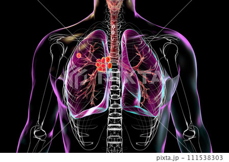 Primary lung tuberculosis, 3D illustration 111538303