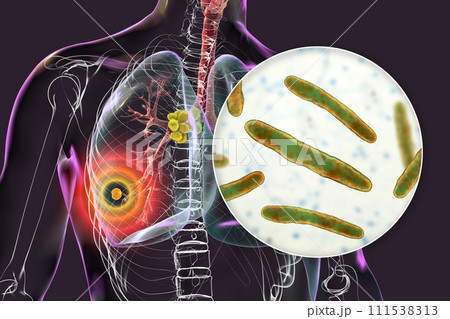 Primary lung tuberculosis, 3D illustration Primary lung tuberculosis, 3D illustration 111538313