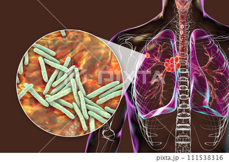 Primary lung tuberculosis, 3D illustration Primary lung tuberculosis, 3D illustration 111538316