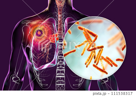 Primary lung tuberculosis, 3D illustration Primary lung tuberculosis, 3D illustration 111538317