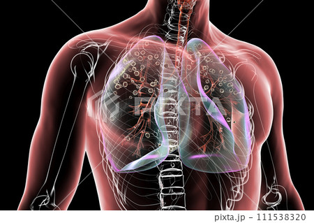 Human lungs with silicosis, 3D illustration 111538320