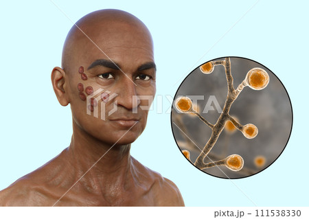 A man with cutaneous blastomycosis, 3D illustration 111538330