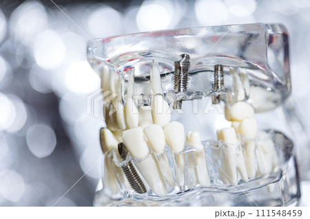 Dental tooth implant titanium prosthetic dentists model. Dental tooth implant titanium prosthetic dentists model. 111548459