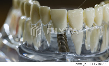 Dental implant, artificial tooth roots into jaw, root canal of dental treatment 111548636