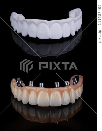 Two stages of making full dental zirkonium prosthesis on titanium bar. Raw before sintering and layered or painted zirkonium. 111587409