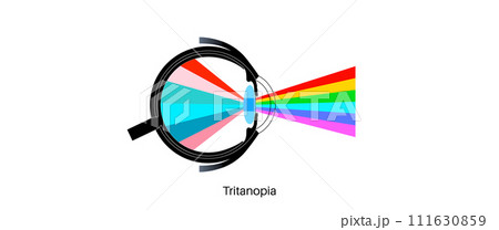Tritanopia and tritanomaly Tritanopia and tritanomaly 111630859
