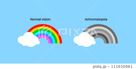 Achromatopsia vision deficiency Achromatopsia vision deficiency 111630861