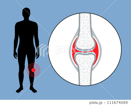 Hemarthrosis in the synovial joint 111674089