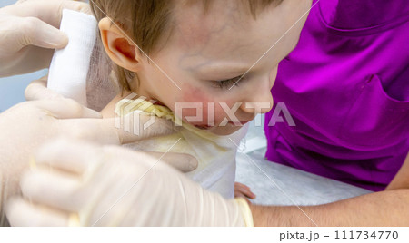 dressing a boy with a burn from boiling water dressing a boy with a burn from boiling water 111734770