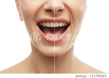 Oral care and hygiene. Half-face comparison with smile showing healthy and white teeth. Collage. Concept of natural beauty and medicine 111749283