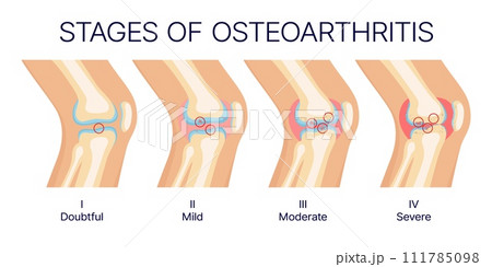 Knee osteoarthritis stages, human knee joints and bones anatomy. Vector medical diagram of arthritis disease stages with healthy and injured cartilages, arthritic inflammation, medicine themes 111785098
