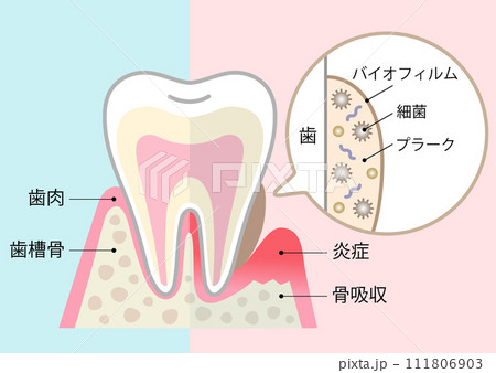 バイオフィルムと健康な歯 111806903