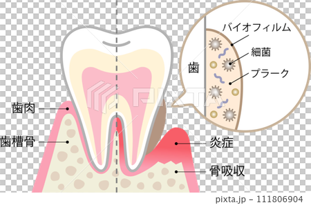 バイオフィルムと健康な歯 バイオフィルムと健康な歯 111806904