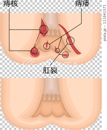 肛門痔瘡圖解中文 111841371