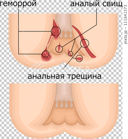 肛門 痔 イラスト ロシア語 肛門 痔 イラスト ロシア語 111841373