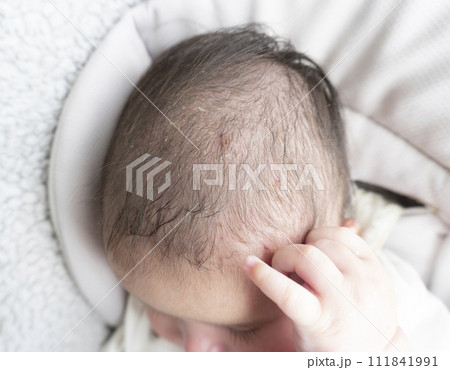 掻きすぎて頭皮に傷ができている赤ちゃん 掻きすぎて頭皮に傷ができている赤ちゃん 111841991