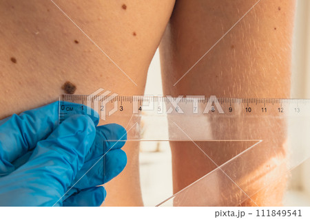 Dermatologist checking sizes of male birthmarks with ruler. Doctor examining length and width of benign moles on man skin 111849541