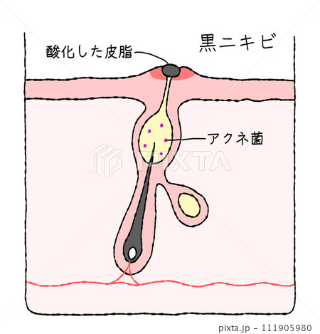 ニキビの構造　黒ニキビ 111905980