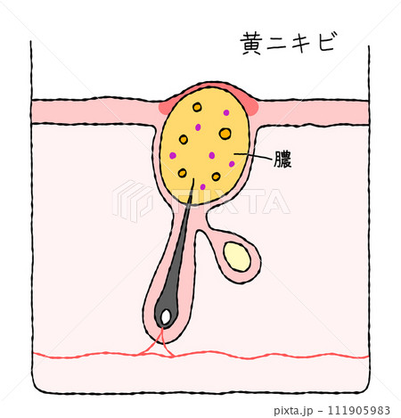 ニキビの構造 黄ニキビ ニキビの構造 黄ニキビ 111905983