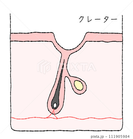 ニキビ跡の構造　 111905984