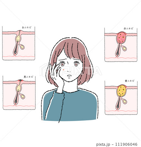 ニキビの構造と女性 111906046