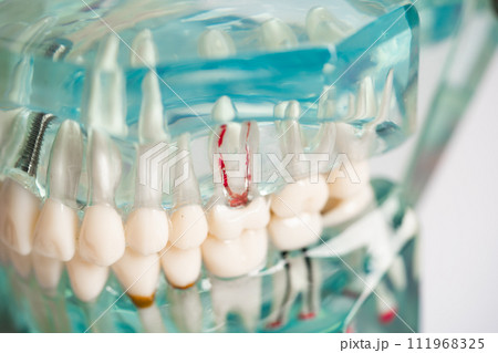 Dental implant, artificial tooth roots into jaw, root canal of dental treatment, gum disease, teeth model for dentist studying about dentistry. Dental implant, artificial tooth roots into jaw, root canal of dental treatment, gum disease, teeth model for dentist studying about dentistry. 111968325